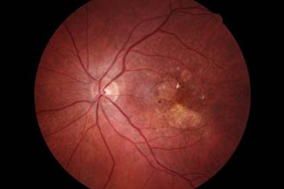 Macular Degeneration image