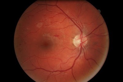 Diabetic Retinopathy image