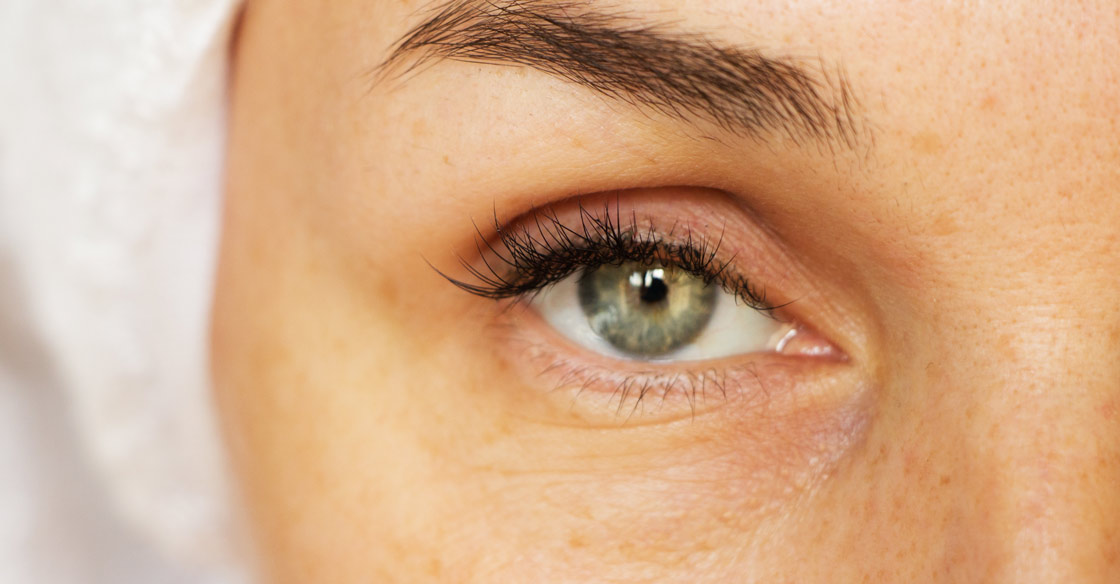 what causes puffy eyes